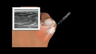 Sonoguided Posterior Bursal injection of Shoulder [upl. by Dygal]