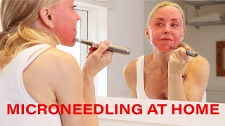 Microneedling DIY at Home  Tips Warnings and Demo  Over 50 [upl. by Bentley]