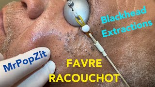 Favre Racouchot syndromeDozens of comedones extractedWhiteheads and blackheads Clearing the pores [upl. by Haisoj]