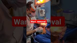 लेजर ट्रीटमेंट मस्सा निकालने के लिए सर्वोत्तम विकल्पquotwart removal by laser treatment wart [upl. by Elmajian570]