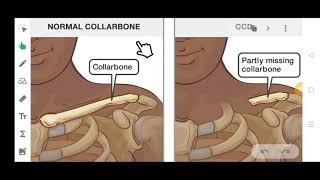 CLEIDOCRANIAL DYSPLASIA  IN JUST 5 MINUTES  SIMPLE AND EASY [upl. by Asilrak]