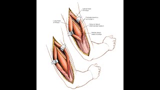 Posterior Approach to Humerus [upl. by Viking801]