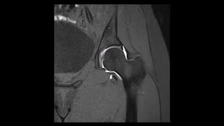 Hip MRI Arthrogram Contrast in Joint Normal No Pathology [upl. by Paapanen137]