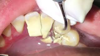 Houston Cosmetic DentistTartar Tartar Tartar How we remove it [upl. by Kleeman904]