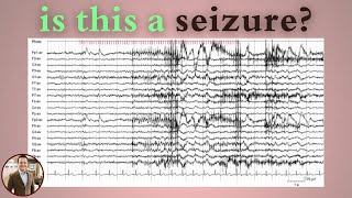 Photomyoclonic Response on EEG Not a Seizure Here’s Why [upl. by Goldman]