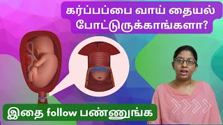 Cervix stitch போட்டவர்கள் எப்படி இருக்கணும் Normal delivery ஆகுமா [upl. by Ferwerda753]