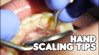 Dental Cleaning  Hand Scaling Tips [upl. by Audy295]