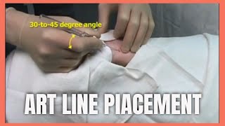 Arterial Line placement For monitoring arterial Blood pressure [upl. by Gamber]