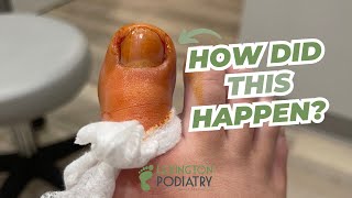 Partial TOENAIL Removal [upl. by Enileoj296]