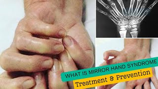 What Is Mirror Hand Syndrome [upl. by Schaper]