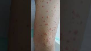 Guttate psoriasis  psoriasis skin psoriasisawareness psoriasissolution dermestidscanada short [upl. by Zigrang]