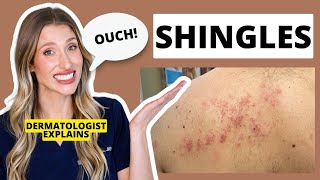 Dermatologist Explains Shingles Is it Contagious Shingles Treatments amp Prevention  Dr Sam Ellis [upl. by Amir515]