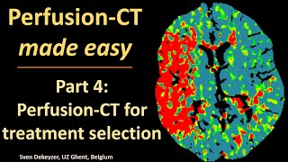 Perfusion CT made easy  part 4  perfusionCT for patient selection [upl. by Hales]