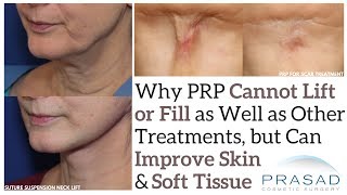 Why PRP Can Improve Neck Skin but Cannot Lift and Options for Neck Rejuvenation [upl. by Snook]