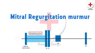 Mitral regurgitation murmur [upl. by Chantalle]