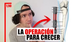 LA OPERACIÓN PARA SER MÁS ALTO  ALARGAMIENTO ÓSEO [upl. by Tera990]