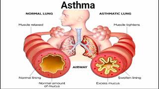 normal lung vs asthmetic lung  asthma symptoms  biology class 9 by Last moment tuitions [upl. by Anawed]