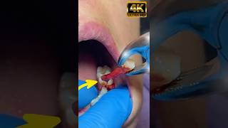 How can a simple abcessed turn into root canal or tooth loss toothextraction rootcanaltreatment [upl. by Bertila]