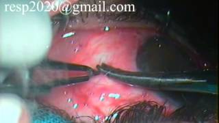 Conjunctival Graft Suturing For Pterygium Excision With Autograft By Dr Sudhir Singh 33 [upl. by Lleral]