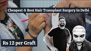 Live Hair Transplant Surgery in Delhi hairtransplantresult [upl. by Oknuj5]