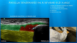 Ultrasound of Patella Tendinosis in an 18 Year Old Male by probeultrasound [upl. by Dicky]