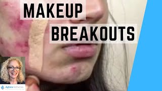 MAKEUP CAUSES ACNE  BREAKOUTS  WHAT TO DO [upl. by Yentruoc]