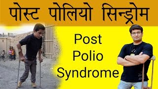 Post Polio Syndrome Treatment  Lalit Kumar  WeCapable  Dashamlav [upl. by Doownyl]