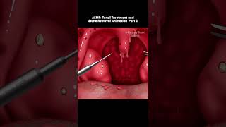 ASMR Tonsil Treatment and Stone Removal Animation Bad Breath Part 2 [upl. by Leinoto]