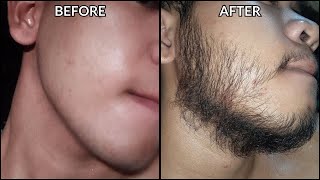 Minoxidil Beard Journey 3 MONTH TRANSFORMATION  BEFORE and AFTER [upl. by Reisch]