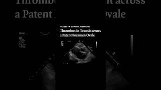 Thrombus in Transit across a Patent Foramen Ovale  NEJM [upl. by Robet]