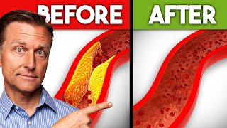 Best Nutrients to Remove Plaque from Arteries [upl. by Yevrah200]