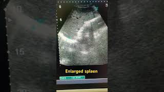 Spleen siz splenomegaly ultrasound ytviral medical study spleen shortfeed shortviral abdomen [upl. by Robyn]