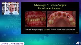 Optimizing implant dentistry A New approach to managing Hopeless Endodontically Treated Teeth [upl. by Matland]