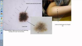 Dermoscopy Made Simple  Reed nevus [upl. by Adnohsel]