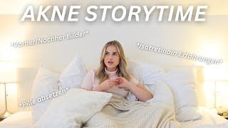 AKNE STORYTIME  Pille absetzen Isotretinoin Erfahrungen amp VorherNachher Bilder ✨ [upl. by Esyla123]