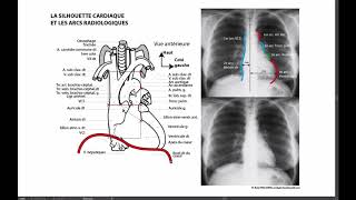 Silhouette cardiaque et arcs radiologiques [upl. by Morville]