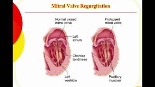 Valvular Disease [upl. by Samuel]