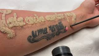 Detatouage Laser Tattoo removal Laser [upl. by Groot]