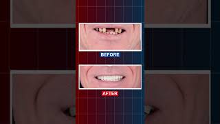 All on 4 Dental Implants in Bodrum Turkey AMAZING Before amp After [upl. by Bollen870]