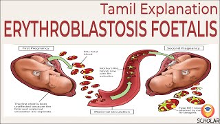 Understanding Erythroblastosis Fetalis Causes Symptoms and Treatments  Tamil Explanation [upl. by Allwein]