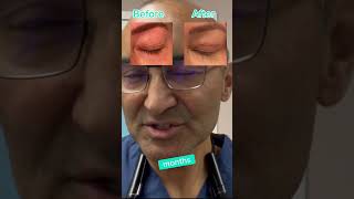 JOURNEY OF BLEPHAROPLASTY  DR TANVEER JANJUA NEW JERSEY [upl. by Leibman197]