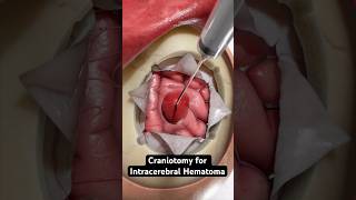 Removing pooled blood from the brain 3D Animation [upl. by Dnamron]