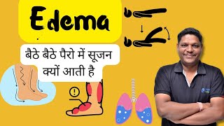 Edema in Hindi  बैठे बैठे पैरो में सूजन क्यों आती है  Types causes risk factor  Bhushan Science [upl. by Rudiger]