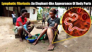 Elephantiasis Or Lymphatic Filariasis An Elephantlike Condition That Afflicts Millions Worldwide [upl. by Thissa]