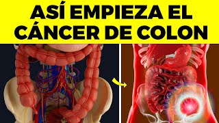 Las 10 PRIMERAS SEÑALES de CÁNCER DE COLON que nunca debes ignorar [upl. by Sehcaep603]