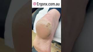 Cracked heels removal by podiatrist in australia [upl. by Boigie]