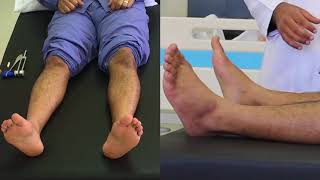 Diabetic foot examination [upl. by Nelyak]