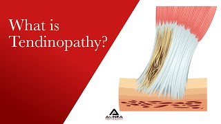 What is Tendinopathy [upl. by Mcclure]