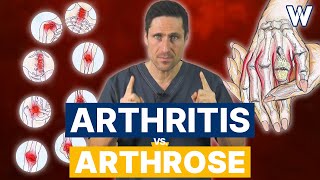 Arthrose vs Arthritis Gibts Unterschiede Ursachen und Therapien von Gelenkschmerzen [upl. by Schuman]