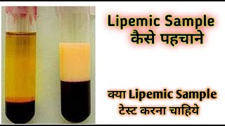 Lipemic blood sample  Lipemic  Lipemic serum [upl. by Nnylatsirk753]